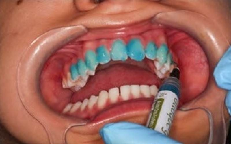 Coluna Weider: Restabelecimento estético com cirurgia periodontal a laser e lentes de contato