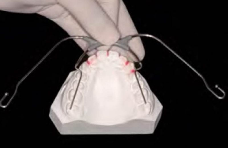 COLUMN HOW TO DO IT: Thurow maxillary splint headgear: indication, production and a case report