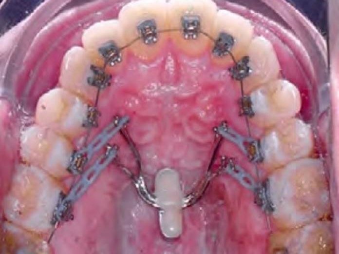 Coluna Ortodontia e Ideias: Tratamento da Classe III com protração e retração em massa utilizando ancoragem esquelética