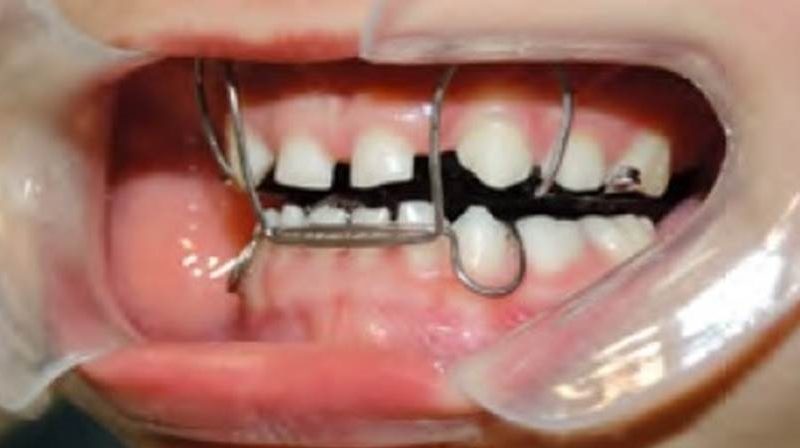 Mordida cruzada anterior e posterior na dentição decídua: uma nova proposta de tratamento – relato de caso