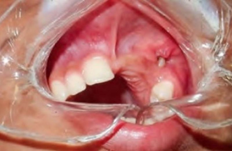 Descompressão para tratamento de extenso cisto dentígero em maxila – relato de caso
