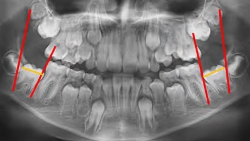 Prognosis between superior permanent canines teeth eruption axis and second lower molars space for eruption