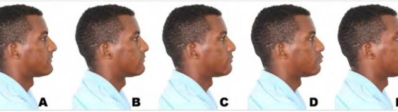 Avaliação da percepção estética de alterações no perfil facial em indivíduo negro