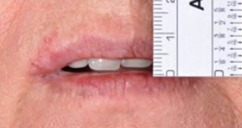Coluna Prótese Total – Parâmetros para determinar o comprimento dos dentes anteriores superiores em pacientes edêntulos