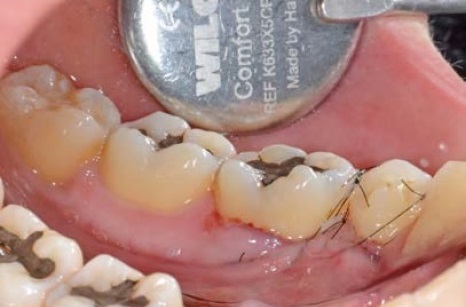 Cirurgia plástica periodontal: técnica do envelope aplicada na correção de defeito gengival lingual