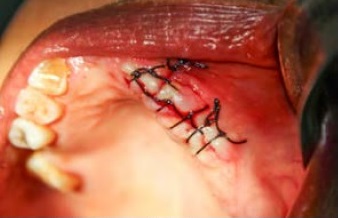 Exodontia tardia de dentes inclusos, complicações associadas – relato de caso