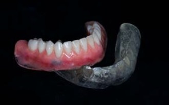 Coluna Prótese Total – Técnica de moldagem para sobredentadura dento-retida