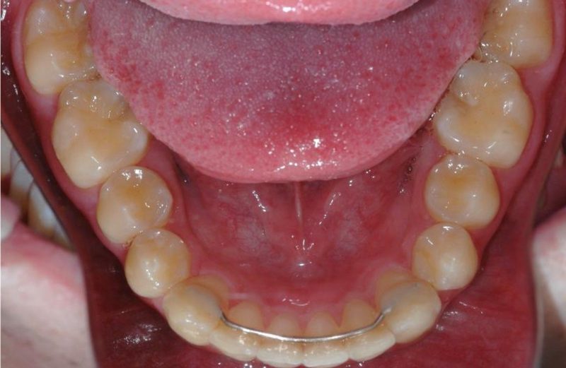 Intermaxillary elastics and passive self-ligating brackets in the treatment of dentoalveolar Class II: a synergistic relationship