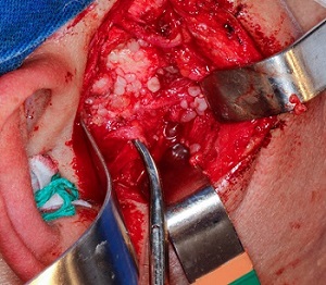Condromatose sinovial unilateral da articulação temporomandibular após trauma local – relato de caso