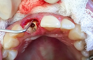 Extrusión dental rápida con fines protésicos – informe de un caso