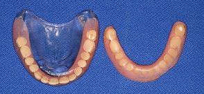 Restoration of intermaxillary relations by conventional complete denture