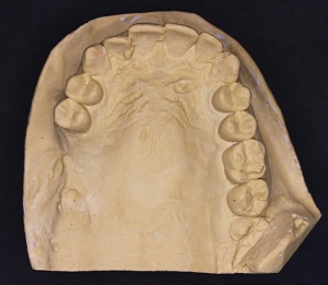 Rehabilitación protésica después de una extensa fractura dento-alveolar – informe de caso