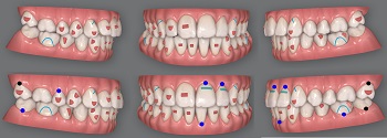 Treatment of Class II malocclusion with Invisalign