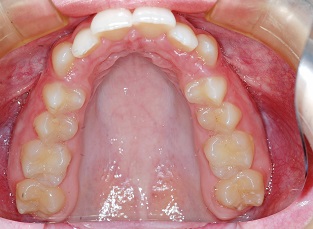 Column Orthodontics and Ideas – Class II treatment with modified Herbst – case report