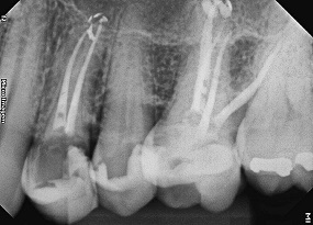 Presencia de canal mesiobucal 2 en primeros molares maxilares – serie de casos