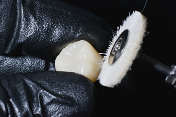 Reabilitação oral com coroa cerâmica fresada em CAD/CAM em dente com ampla destruição coronária – relato de caso