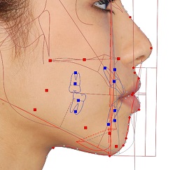 Perception of female chin attractiveness by maxillofacial surgeons, orthodontists and lay people