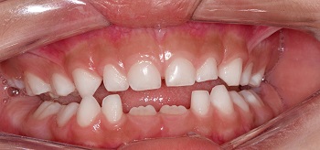 Planas direct track for functional anterior crossbite treatment – case report