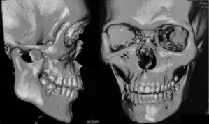 Surgical treatment of nasal fracture twenty years after trauma