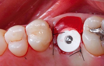 Reabilitação implantossuportada de molar superior com implante cônico interno de diâmetro extra-largo – relato de caso