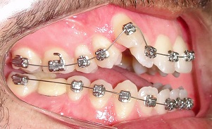 Compensatory treatment of Class II and skeletal open bite with selfligating brackets – case report