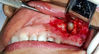 Remoção cirúrgica de terceiro molar ectópico em seio maxilar – relato de caso