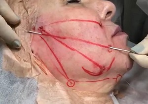 Uso de fios faciais de tração como um meio para o rejuvenescimento facial – relato de caso