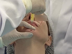 Preenchimento facial com uso de material autólogo plasma gel – relato de caso