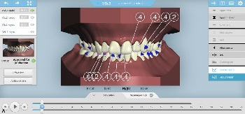 Ortodoncia digital con alineadores ortodónticos – Sistema Cleartek