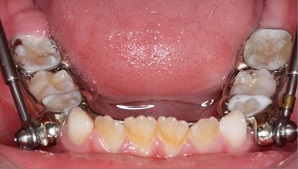 Classe II, divisão 1 – da dentição mista à permanente com aparelho ortopédico funcional e fixo
