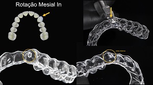 Activation of orthodontic aligners with pliers – an alternative to obtain the results