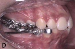 How-to Column – How to perform a three-dimensional analysis of the upper airways in orthodontic patients?