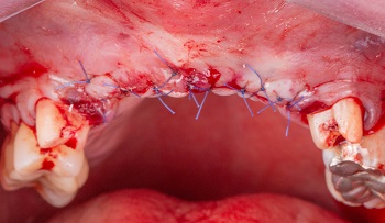 COLUNA INFORMAÇÃO E TECNOLOGIA – Fluxo de trabalho digital para cirurgia de regeneração óssea com bloco xenógeno fresado, associado a implante dental