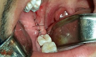 Tratamento de terceiros molares inclusos através da técnica coronectomia – aspectos clínicos