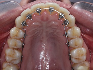Orthodontic and surgical treatment with the lingual technique