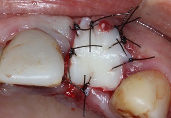 Reabilitação dentária em região anterior com implante imediato e reconstrução alveolar por meio de enxertos conjuntivo autógeno e ósseo xenógeno