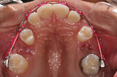 Taurodontism – series of case reports in non-syndromic and syndromic young patients associated to hypodontia