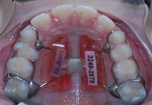 Treatment in two stages of pattern II with Class II, division 1 malclusion by maxillary protrusion