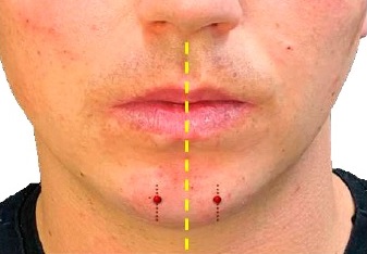 Reestruturação do terço inferior da face com ácido hialurônico