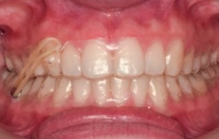 Treatment of class II/2 malocclusion with clearcorrect® aligners – case report