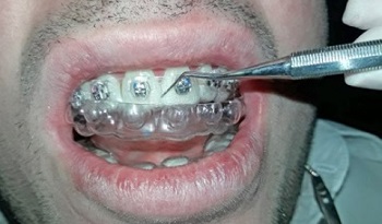O uso da tecnologia CAD/CAM na Ortodontia: setup ortodôntico e colagem indireta pelo sistema eXceed™
