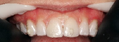 Clinical protocol for attachments bonding in cases treated with aligners – Technique Description