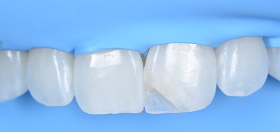 Coluna Sakamoto – Técnica de estratificação natural em dente anterior – relato de caso