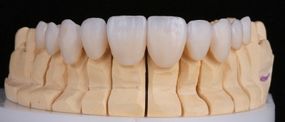 COLUNA INFORMAÇÃO E TECNOLOGIA – Correção da discrepância vertical dental através de facetas laminadas de cerâmica e aumento cirúrgico da coroa clínica