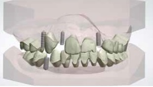 The importance of digital set up in orthodontics