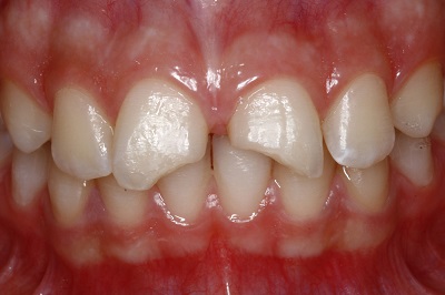 Estratificação, acabamento e polimento de resinas compostas em restaurações de dentes anteriores fraturados – relato de casos