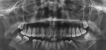 Acompanhamento pós-cirúrgico de dois anos em paciente portadora de fibrodisplasia ossificante progressiva – relato de caso