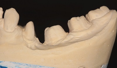 Rehabilitación oral con prótesis fija en un paciente con fallo primario de erupción (FPE) – informe de un caso