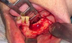 Osteonecrose mandibular induzida por uso de bisfosfonatos – relato de caso