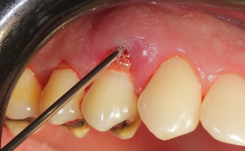 Coluna Pitean – Uso de derivados da matriz do esmalte como coadjuvante da terapia periodontal – relato de caso